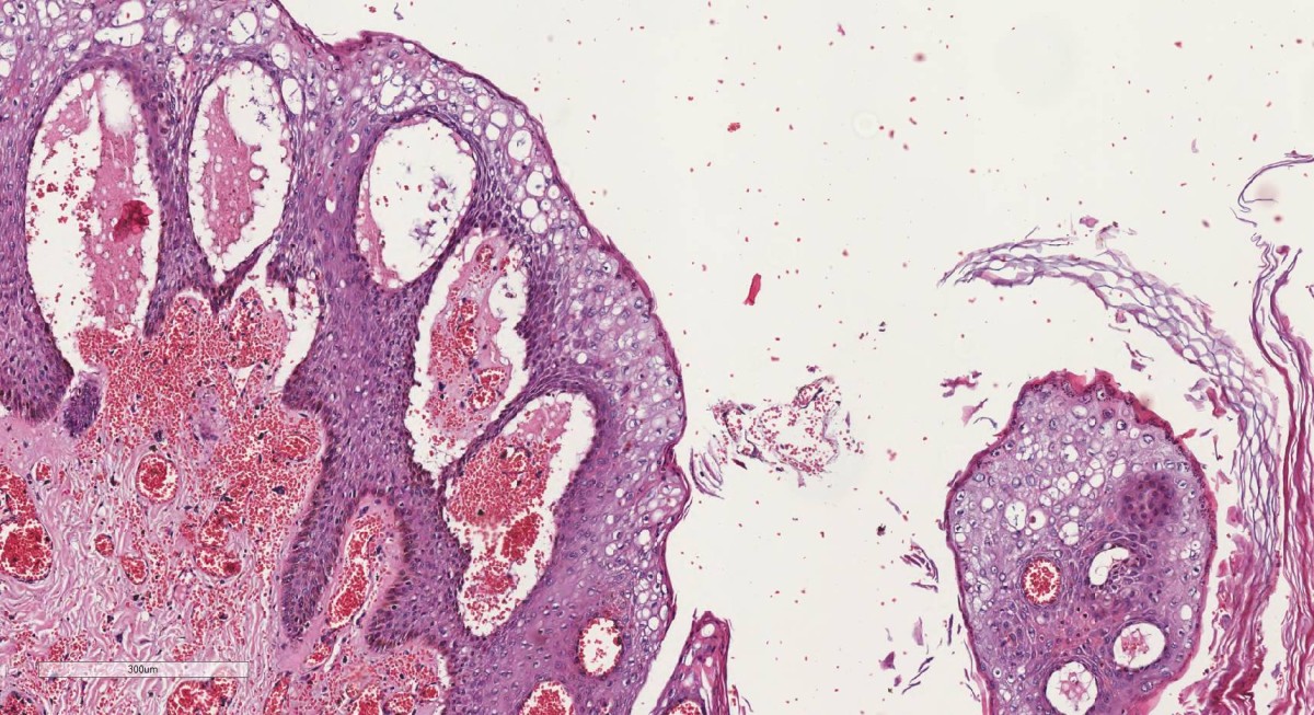 Necrose coagulativa da epiderme. Aumento de 10x